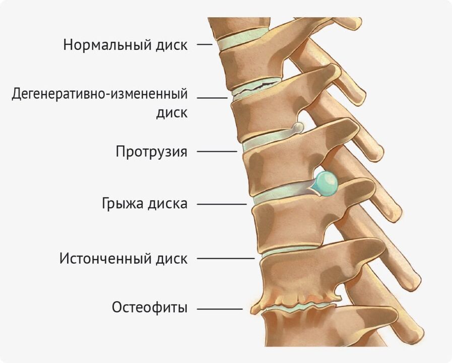 Plate deformation for lumbar osteochondrosis