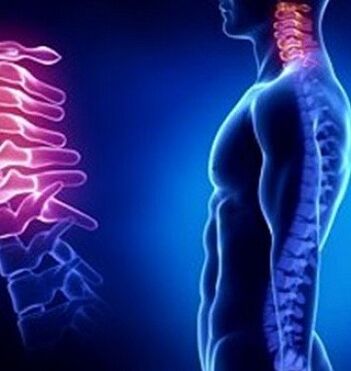 Neck osteochondrosis can be caused by an injury to the neck